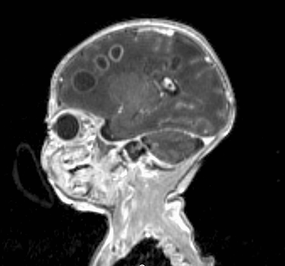 Brain MRI – fronto-parietal and periventricular brain white matter and subcortical abscesses, with signs of cavitation; diffuse cerebral edema.